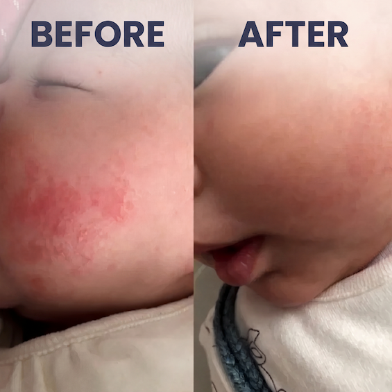Tallow and honey balm - Naturally relieve baby's dry, itchy skin