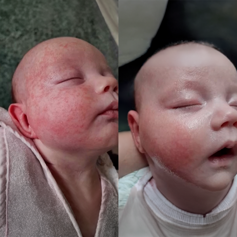"After one week with the butter, the redness was gone"