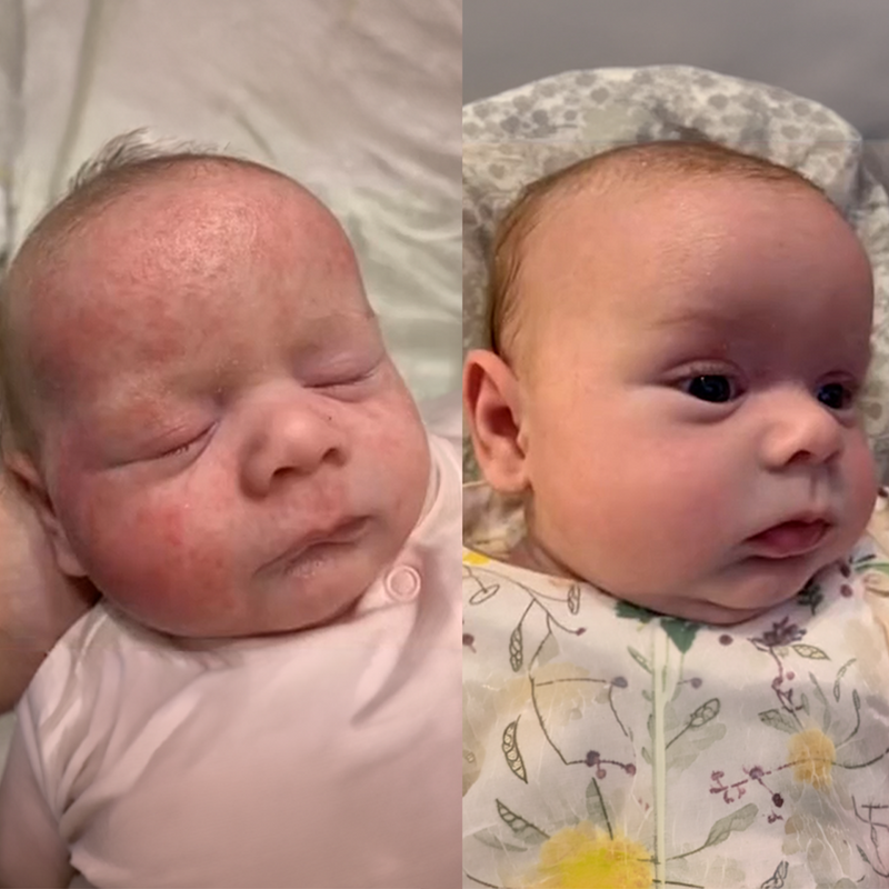 "After 10 days her skin looked like a completely different baby's skin"